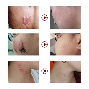 40 g Lanbena akne removal cream popravila madeže, akne acne zdravljenje strij za beljenje blackhead za nego kože